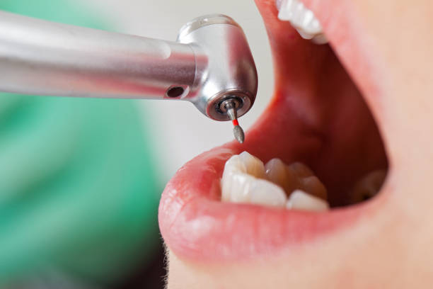 Best Emergency Root Canal Treatment in Converse, TX